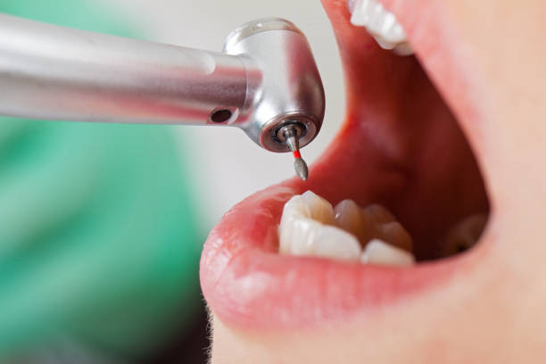 Best Emergency Treatment for Dental Infections or Abscesses in Carey, ID